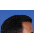 After Hair Transplant&nbsp;Front